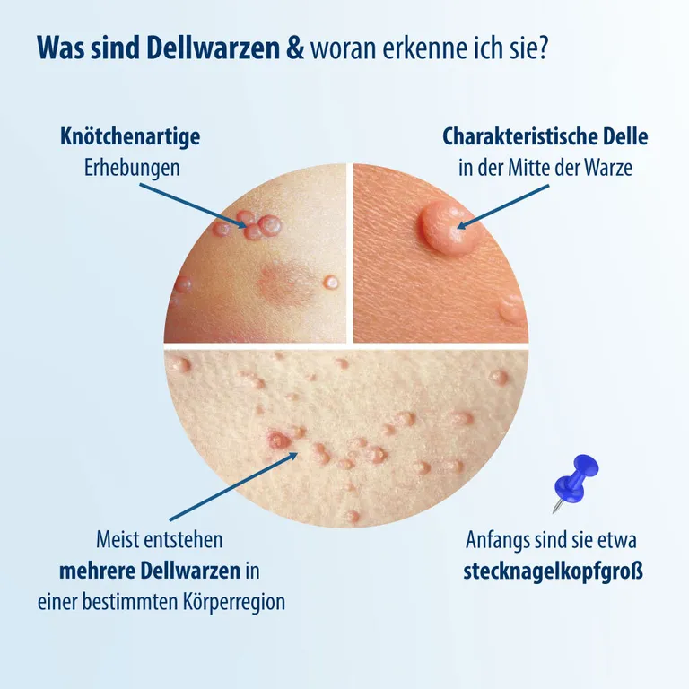 shopapotheke Evolsin® Dellwarzen Mittel I Für Erwachsene & Kinder ab 2 Jahren I Dellwarzen Behandlung mit Ätzkali Osterangebot