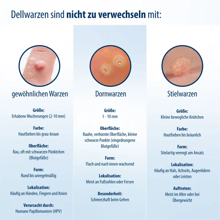 shopapotheke Evolsin® Dellwarzen Mittel I Für Erwachsene & Kinder ab 2 Jahren I Dellwarzen Behandlung mit Ätzkali Osterangebot